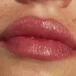 PRP Therapy